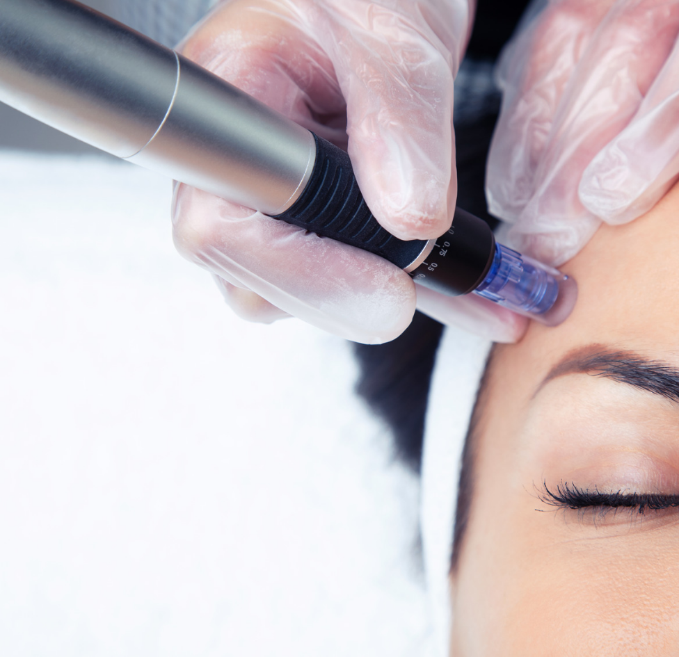 Microneedling